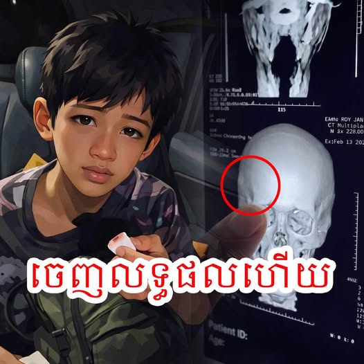 អាណិតខ្លោចចិត្ត! ថតរួច គ្រូពេទ្យ បញ្ជាក់ច្បាស់ៗថា អាការដែលធ្វើឱ្យឈាមច្រមុះ និងឈឺក្បាលពឺតៗ គឺដោយសារ…