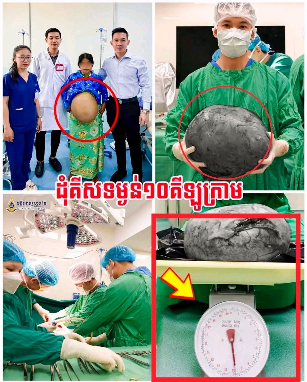 ជោគជ័យដ៏គួរឱ្យកត់សម្គាល់! មន្ទីរពេទ្យ ហ្លួង ម៉ែ វះកាត់យកគីសដៃស្បូនទម្ងន់ ១០គីឡូក្រាម ចេញពីអ្នកជំងឺបានដោយសុវត្ថិភាព